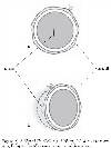 Slipped PlastiBell ring causing a) tourniquet, b) meatal obstruction