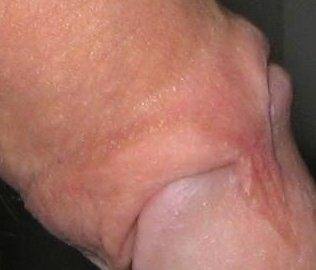 skin bridge 25-flaccid