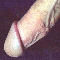 Varicose vein